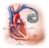 Pacemaker device implanted in chest to regulate heart rhythm