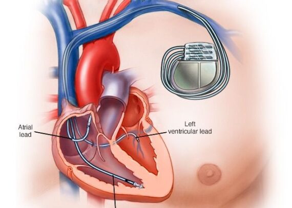 Pacemaker device implanted in chest to regulate heart rhythm