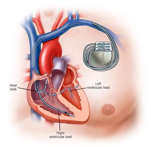 Pacemaker device implanted in chest to regulate heart rhythm