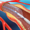 Recovery after angioplasty with heart care tips including rest diet and medication