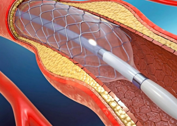 Recovery after angioplasty with heart care tips including rest diet and medication
