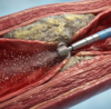 Illustration showing rotational atherectomy using a diamond-tipped burr to remove calcified coronary artery blockage before stent placement