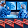 Illustration showing in-stent restenosis where scar tissue causes artery re-narrowing after coronary angioplasty and stent placement.